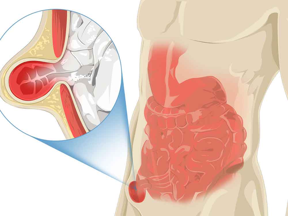 stomach-incisional-hernia-before-and-after-pictures-melanieausenegal